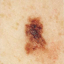 20110606073421-melanoma.jpg