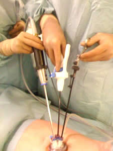 20130602230213-cirugia-laparoscopica.jpg